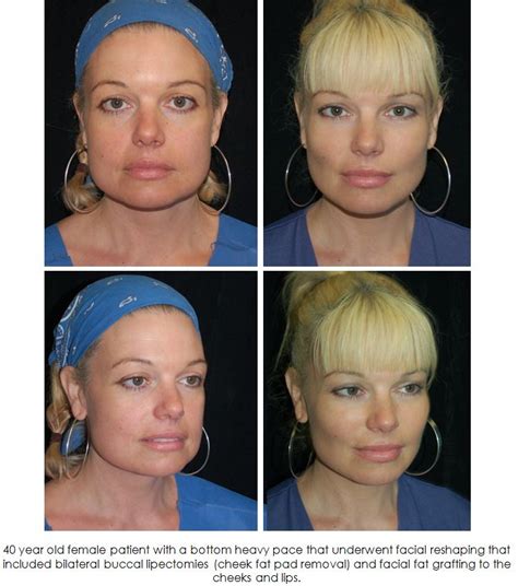 Facial Rejuvenation Fat Grafting Dr Gary Motykie Beverly Hills Los Angeles