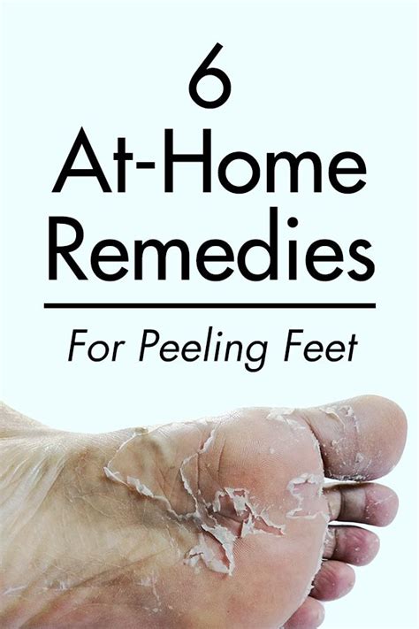 6 At Home Remedies For Peeling Feet Dry Feet Remedies Dry Cracked Feet Cracked Feet Remedies