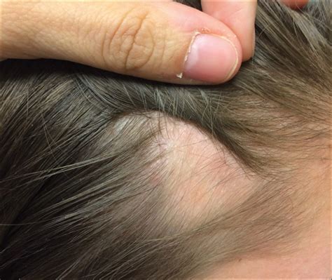 Hair Loss Scalp Psoriasis Folliculitis Scalp Symptoms Pictures