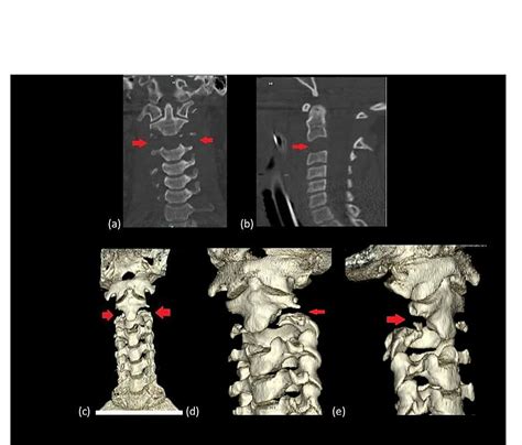 Cervical Spinal Fracture