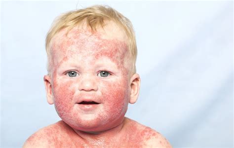 Neurodermitis Bei Kindern So Gehen Sie Mit Der Hautkrankheit Um