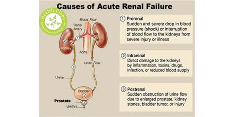 Acute Kidney Injury Classification Diagnosis And Management Health