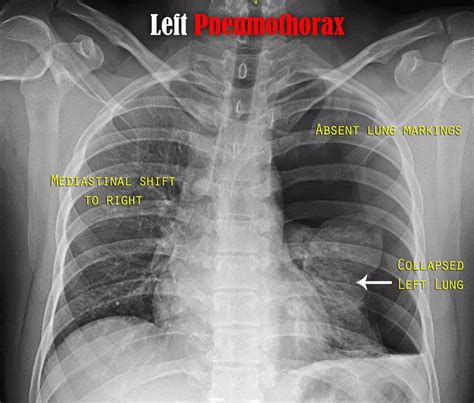 Pneumothorax Geeky Medics