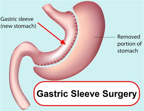 Gastric Sleeve Reviews Surgery Complications Recovery Time And Diet