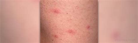 Red Bumpy Rash Cardiovascular Disorders And Diseases Articles Body
