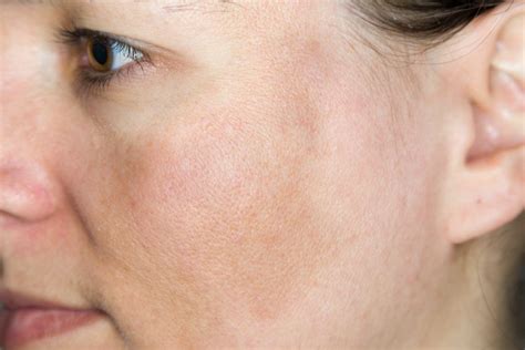 Hyperpigmentation Therapy Usually Do Not Get Started Before You Try