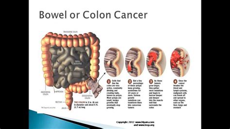 Pain Lower Left Abdomen Pain Lower Left Abdomen Youtube