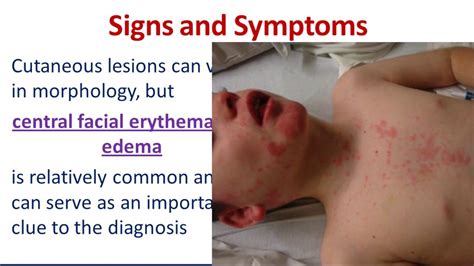 Dermatologic Emergencies 3 Drug Reaction With Eosinophilia And