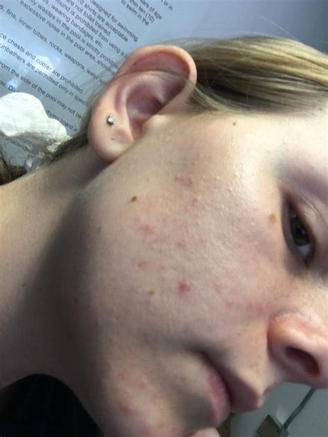 Skin Concerns Ive Been Dealing With Texture On Both Sides Of My Face