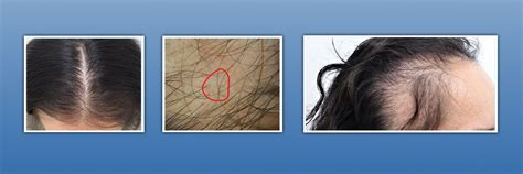 Cicatricial Alopecia 3 Things You Should Know Ishrs