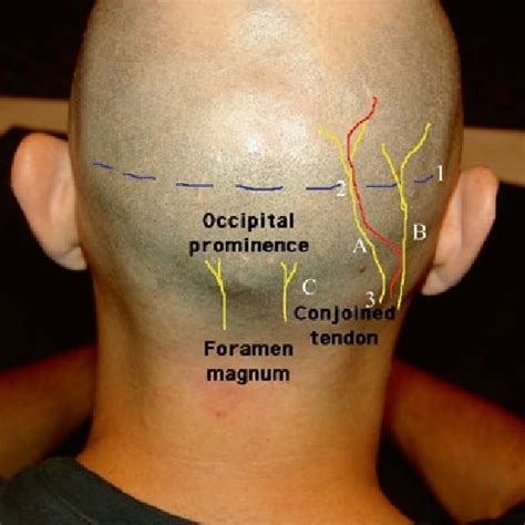 14 Physical Examination Of The Greater Occipital Nerve A Surface