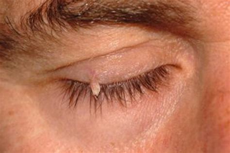 Eyelid Lesions Neil Modi