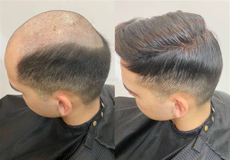 Superior Hair Replacement Before And After