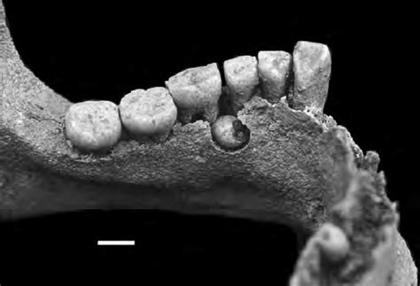 Hyperdontia Skull