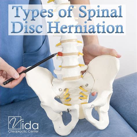 Herniated Disc Causes Symptoms And Treatment Caepv