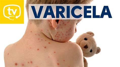 Varicela en niños vacunados sintomas Diario Huesca
