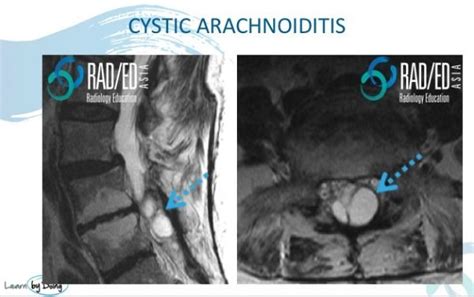 Mri Cord Oedema From Cystic Arachnoiditis Radedasia