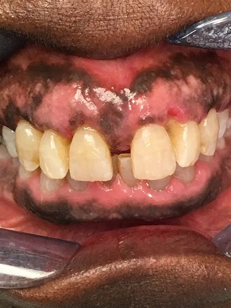 White Spots On Gums And Lips