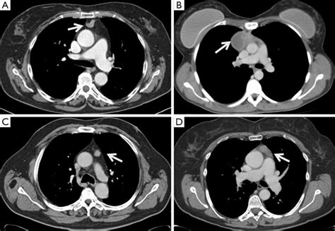 Multi Institutional European Experience Of Robotic Thymectomy For Thymoma Marulli Annals Of