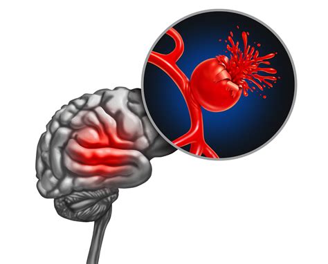Brain Aneurysm Main Risks And Treatment Options Trainfes