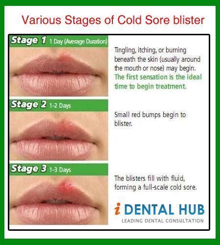 Cold Sores Are Herpes But Np If