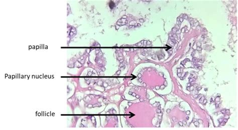 Cystic Cervical Lymph Nodes Metastasis Revealing A Papillary Carcinoma