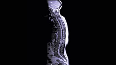 Mri Screening Whole Spine Showing Stock Footage Video 100 Royalty