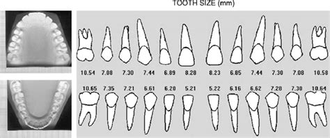 The Results For Mesiodistal Tooth Size Using The Digital Method