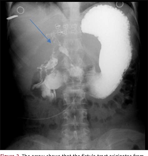Figure 2 From Recurrent Type 1 Enterocutaneous Fistula And