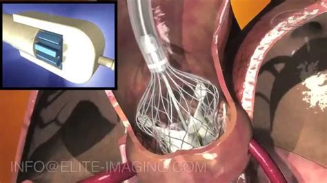 Implantación De Una Válvula Cardiaca Artificial Producción De Videos