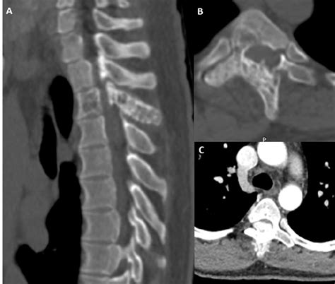 Ct Images Of The Dorsal Spine In Bone Window A In Sagittal Section