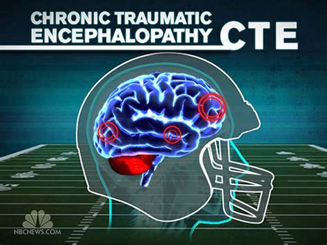 Scientists have known that more years playing tackle. No Such Thing as "Walk it Off" - How Brain Injury Changed ...