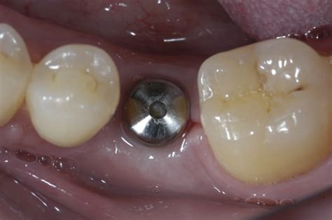 Graft And Lower Molar Implants Graft And Lower Molar Implants