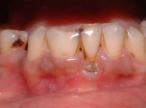 Double Tooth In Mandibular Incisor Region A Case Report Bmj Case Reports