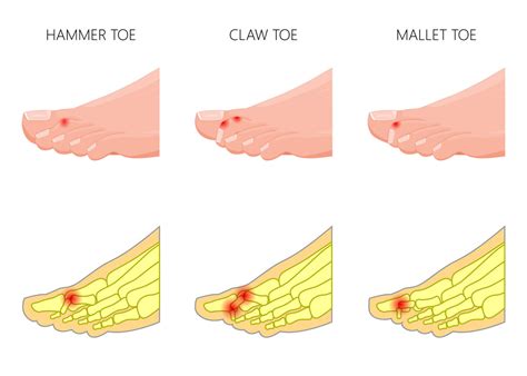 Surgical Non Surgical Treatment Options For Hammertoes The