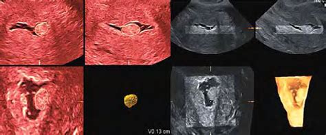 Three Dimensional And 4d Hsg From The Endometrium Normal Cavity