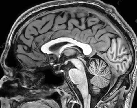 Normal Sagittal T1 Mri Brain 11 Stock Image C0393741 Science