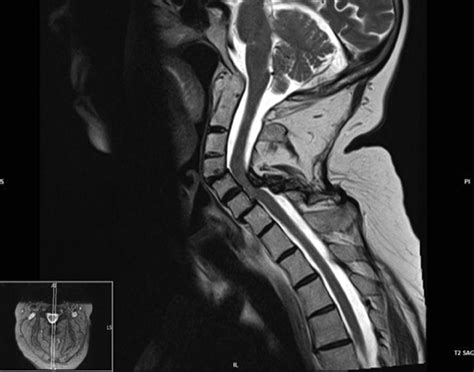 Cervical Mri Demonstrating C5 C6 Severe Spinal Stenosis And Cord