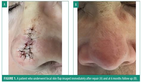 Surgical Outcomes Following Mohs Micrographic Surgery For Basal Cell