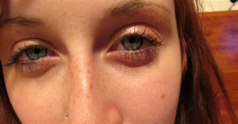 Eye Symptoms Glassy Eyes Symptom