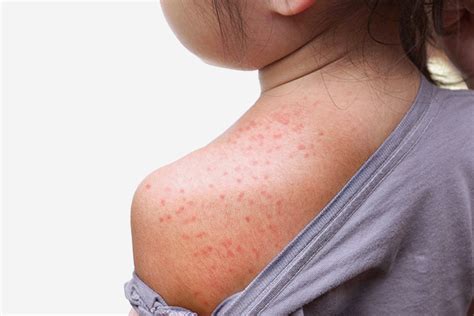 Heat Rashes In Children Types Symptoms And Home Remedies