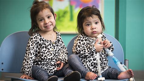 How Do Conjoined Twins Have Sex Formerly Conjoined Twins Thriving After Rare Complex Surgery