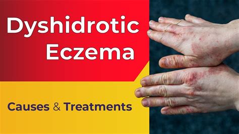 What Is Dyshidrotic Eczema Overview Causes Treatments Youtube