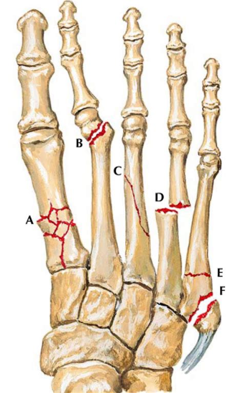 Clínica E Cirurgia Do Pé E Tornozelo Fraturas Dos Metatarsos