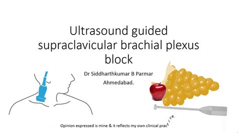 Ultrasound Guided Supraclavicular Brachial Plexus Block Youtube
