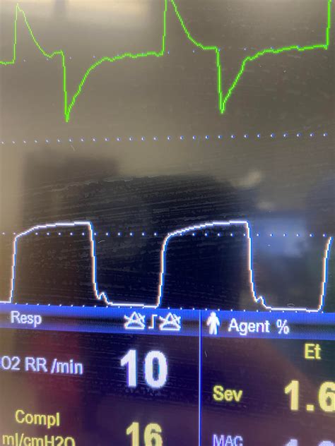 Any Capnography Experts That Can Explain This End Expiratory Hump Rcrna