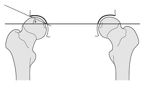 Acetabular Index A Line Is Drawn Between The Points That Represent The