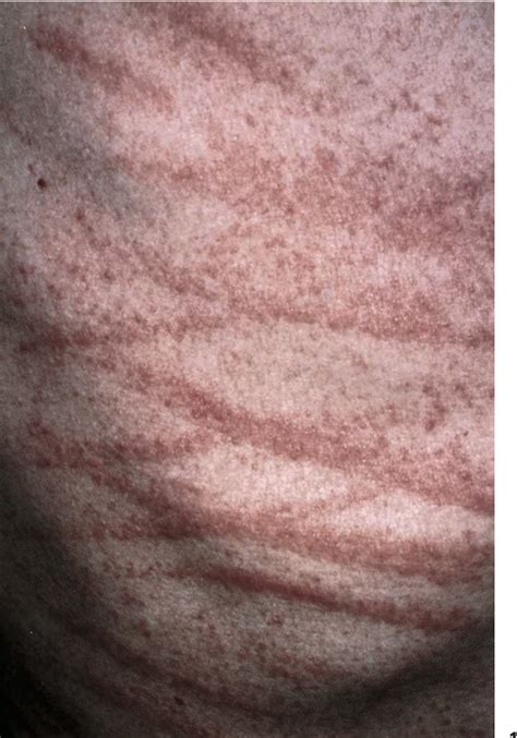 Figure 1 From Flagellate Mushroom Shiitake Dermatitis And