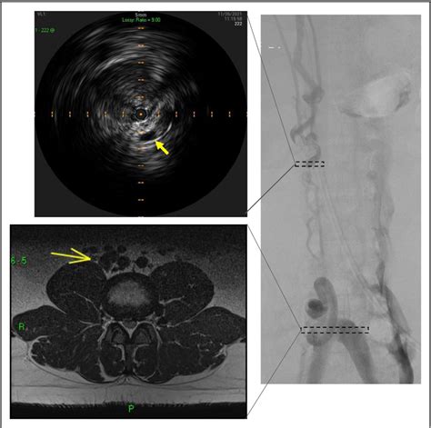 Figure 1 From Lower Limb Weakness Due To Spinal Venous Congestion In