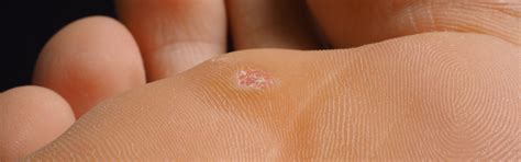 Plantar Warts Verruca Vulgaris Causes And Treatments Elite Podiatry